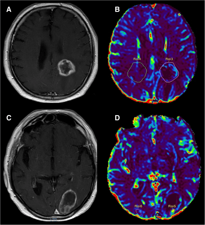 Brain-Tumor-Imaging-kiomedical